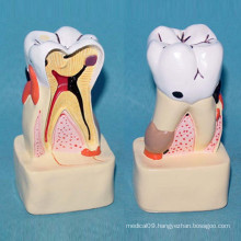 Pathnological Decayed Tooth Anatomic Dental Care Model for Teaching (R080114)